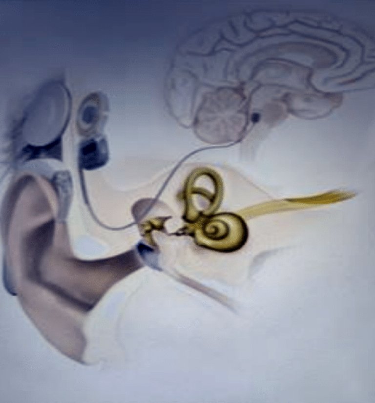 ABI Implantat jpg.jpg